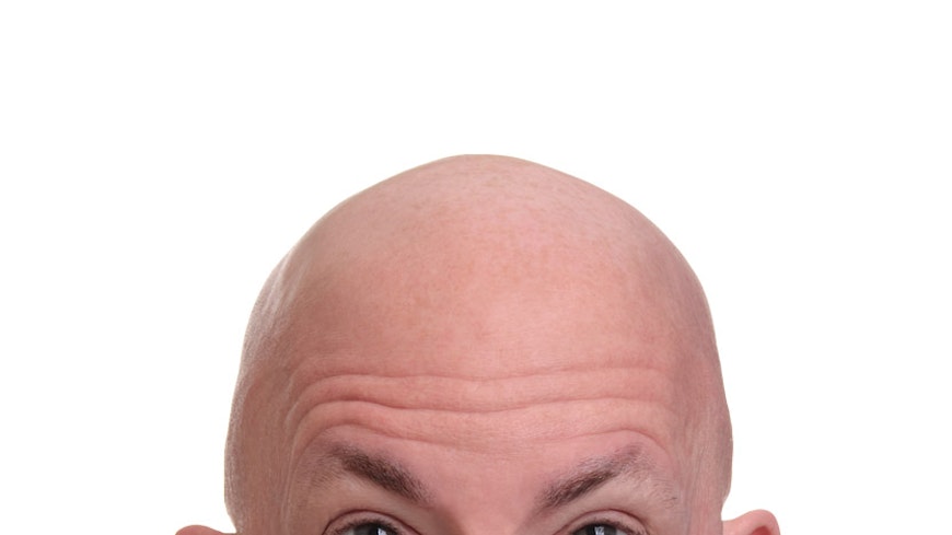 19may consumer in the 80s baldness