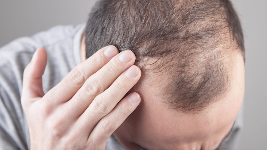 Hair loss width